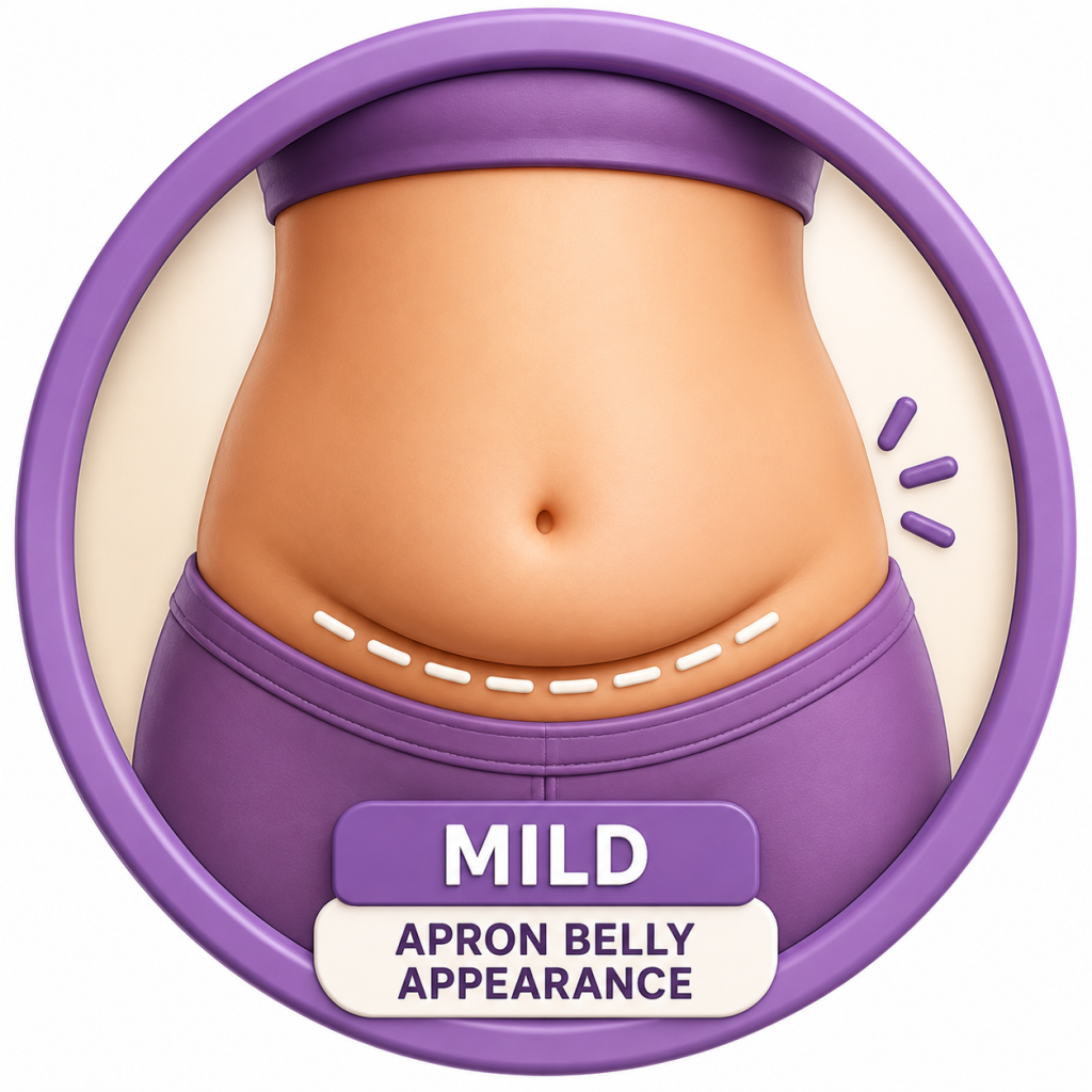 Mild Apron Belly Appearance